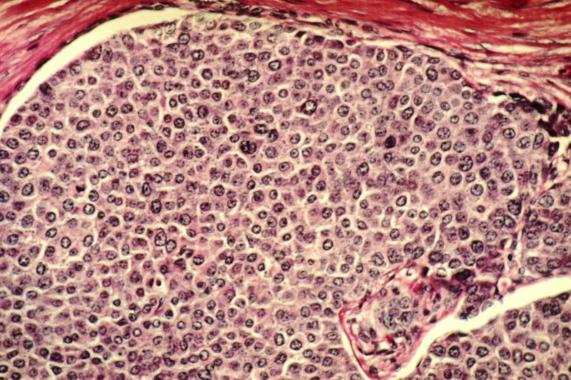 Cancer Cells Exploit Defective Mitochondria to Weaken Immune Defenses